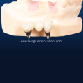 Screw Retained Dental Implant Restoration